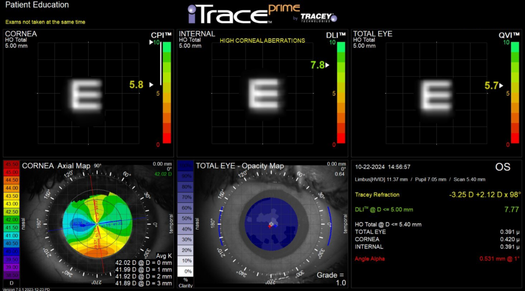 Post-LASIK cornea imaging iTrace